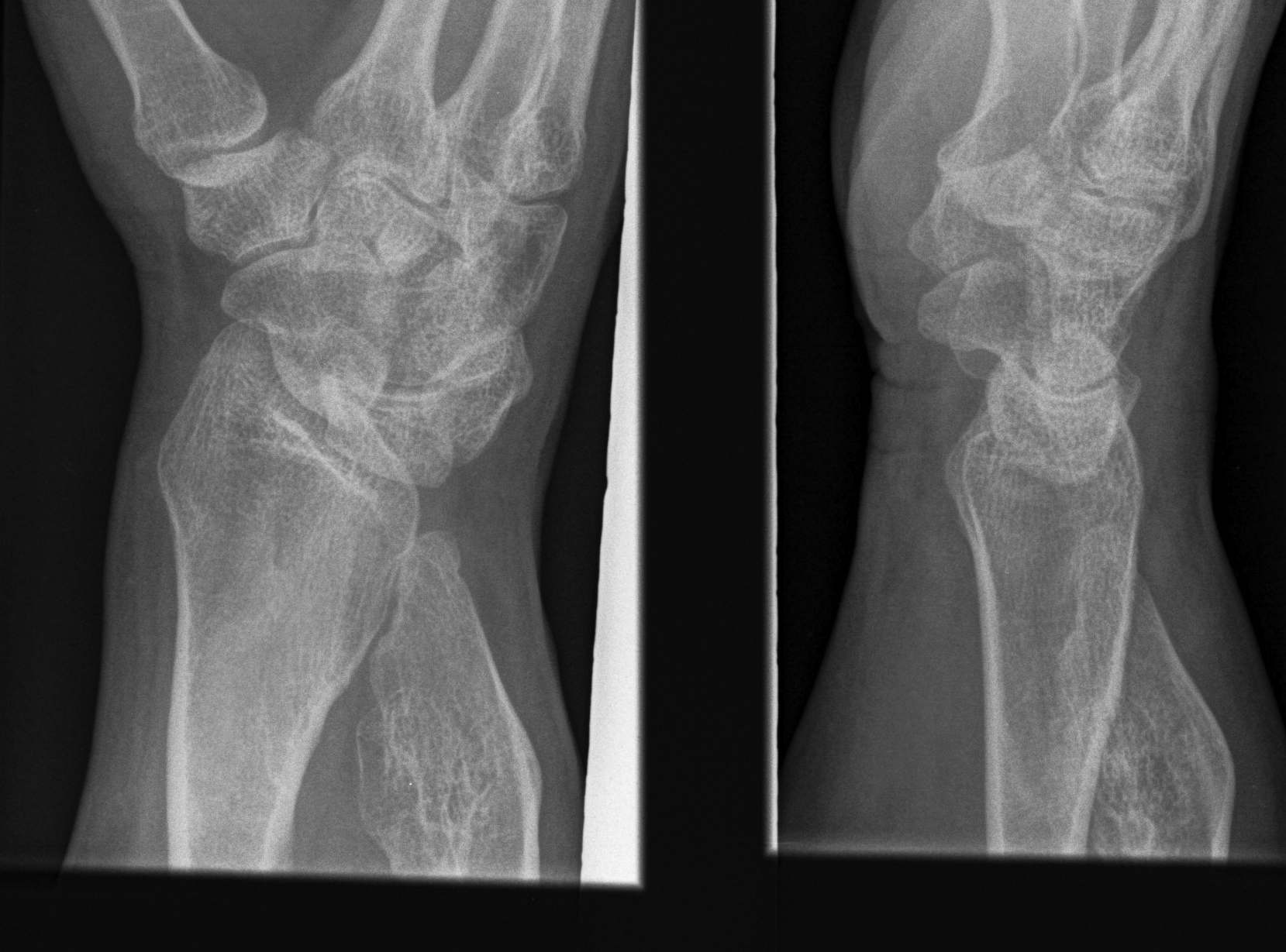 Osteochondromas Wrist Lateral